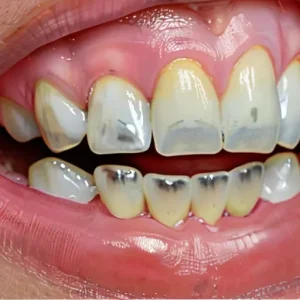 Чувствительность зубов на холодное и горячее: работающие способы реминерализации эмали