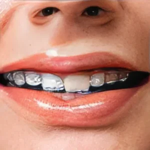 Элайнеры или брекеты: объективное сравнение методов исправления прикуса для взрослых